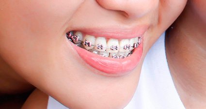 ortodoncia-y-bruxismo