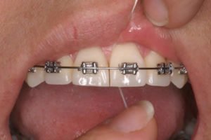 ortodoncia-encías-inflamadas