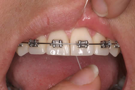 Ortodoncia e inflam...