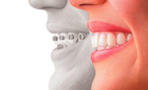 tipos-de-ortodoncia-en-adultos